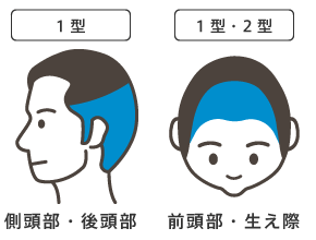 「側頭部・後頭部の薄毛」「前頭部・生え際の薄毛」